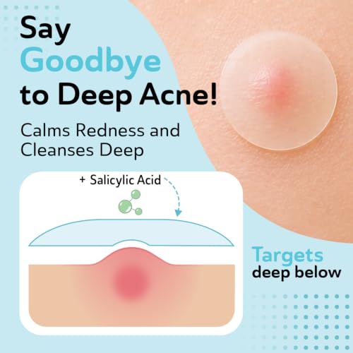 DERMA ANGEL Invisible Salicylic Acid Pimple Patches - 132 Count, 2 Sizes, Redness Relief, Acne & Zit Treatment, Clear & Undetectable