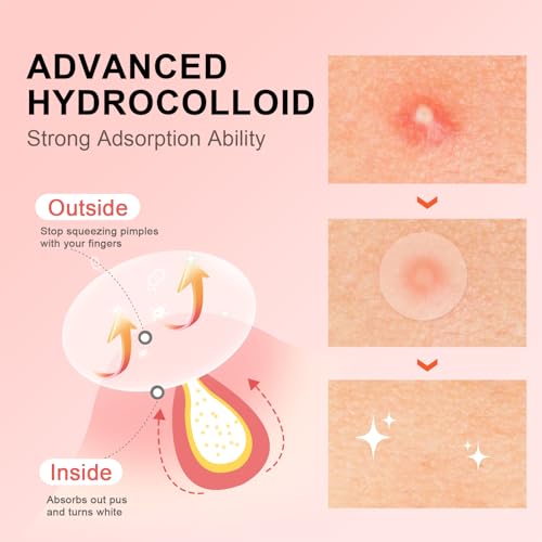 AVJONE Pimple Patches for Face(144 Patches), Hydrocolloid Acne Patches with Tea Tree Oil, pimple stickers for Breakouts, Absorbs Zit, Invisible Spot Cover and Blemish