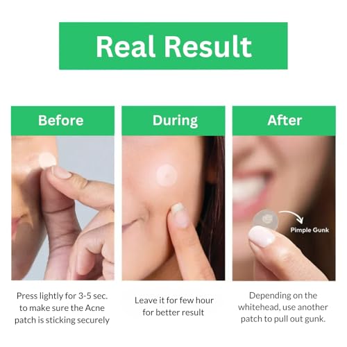 Hydrocolloid Pimple Patches for Face (36ct) ? Invisible 8mm & 12mm Acne Patches for Zits, Pimples & Blemishes, Vegan & Cruelty-Free