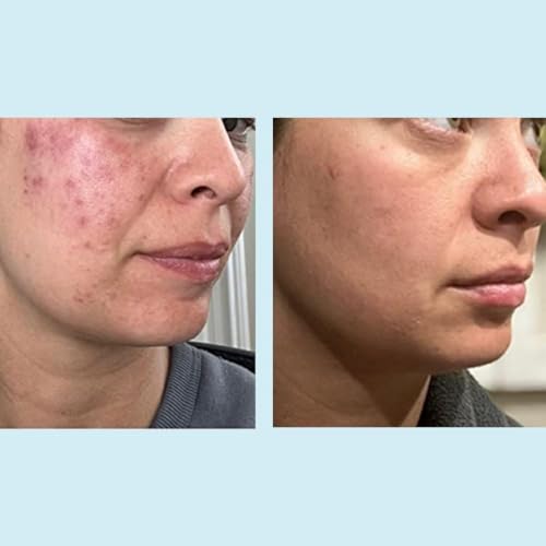 Professional 70% Glycolic Gel Peel with Retinol & Green Tea Extract - For Experienced Users
