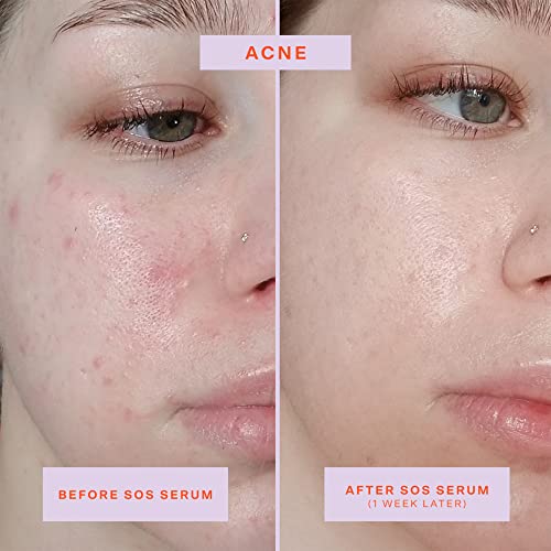 Tower 28 SOS Rescue Face Serum - Soothing Facial Serum with Hypochlorous Acid for Irritated, Sensitive Skin - Gently Helps Reduce Redness + Blemishes - Fragrance-Free Everyday Skin Care (2 oz)