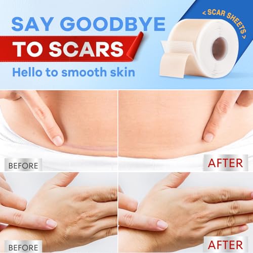 Wifamy Silicone Scar Sheets for Women: Medical Grade Scar Removal C-Section Recovery & Post-Surgery Care (1.6"X 120" Roll-3M)