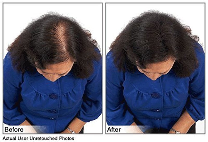 Hair Building Fibers Instantly Conceal Thinning Hair and Bald Spots for Men & Women (Large 28 Grams Bottle) - Undetectable, Washes Away, For All Hair Types, No Animal Byproducts (Medium Brown)