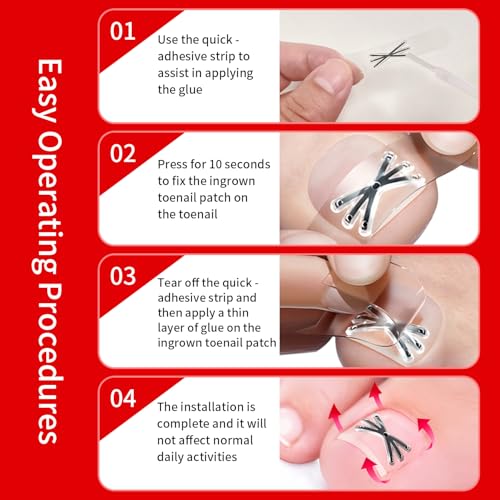 Upgraded Titanium Alloy Ingrown Toenail Corrector with Upgraded 6-Angle Shape,3x Stronger Pull Force,Ingrown Toenail Removal Kit, Ingrown Toenail Treatment for Women and Man (S size - 6 Packs)