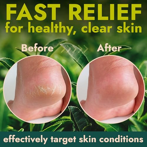 Callus Remover for Feet | Extra Strength Callus Remover Gel for Feet with Tea Tree Oil | Professional-Grade Pedicure Treatment | 50 Applications per Bottle, Includes 3 Pumice Stones | 14 fl oz