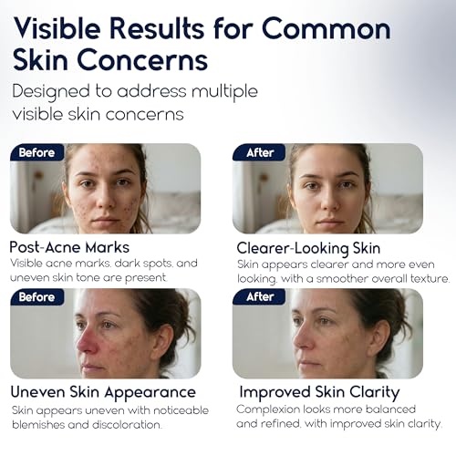 Azelaic Acid 15 Acne Cream for Face - Redness Relief, Rosacea Treatment for Face - Soothes Acne, Hyperpigmentation, Enhanced Formula for Brighter, Healthier Skin Care