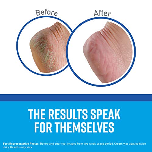 Healthy Feet Foot Cream Tube 4 Pack - Moisturizing Cracked & Dry Feet