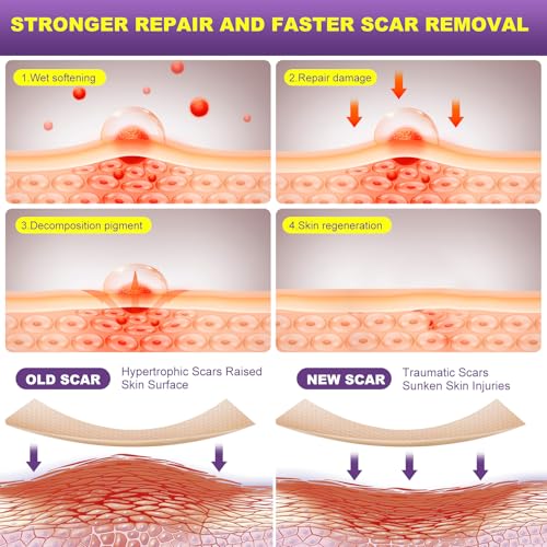 Silicone Scar Sheets, Silicone Scar Tape, Scar Tape for Keloid Bump Removal, Reusable Silicone Scar Strip for C-Section, Keloid, Surgery, Burns, Acne Scar et(1.6¡±x120¡±Roll-3M)