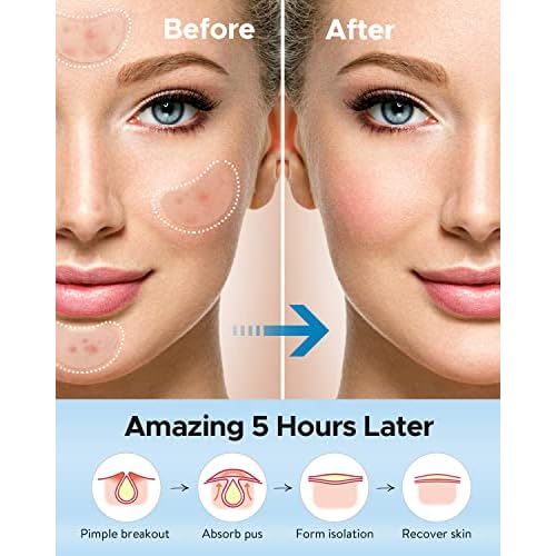 LitBear Acne Patches Large, Hydrocolloid Pimple Patches for Breakouts, Zit and Blemish, Large Acne Patches for Face, Chin, Back and Body with Tea Tree & Calendula Oil