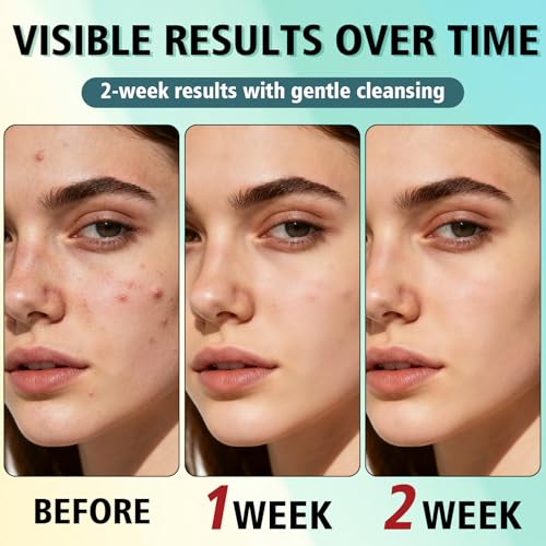 Acne Treatment for Face, Acne Cream, Pimple Cream Suitable for All Skin, Blemish Care Cream for Face and Body, Gentle Daily Skin Care for Oily & Blemish-Prone Skin, Helps Improve Skin Appearance
