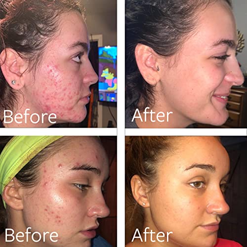 Dr Song Benzoyl Peroxide Acne Wash 10% - Face & Body Treatment - 8 Fl Oz - Variation of THIS listing