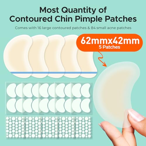 TKTK Chin Pimple Patches (235 Count 6 Sizes), XL Contoured Hydrocolloid Chin Patch 62x42 mm, Large Acne Patch for Face Blemishes Zit Breakouts, Maximum Absorption Overnight Stickers