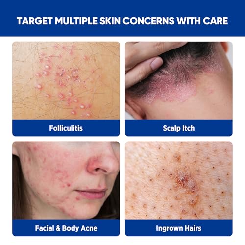 AOSORW Folliculitis & Acne Treatment Cream with Salicylic Acid & Herbal Extracts - 100g for Face, Body & Scalp