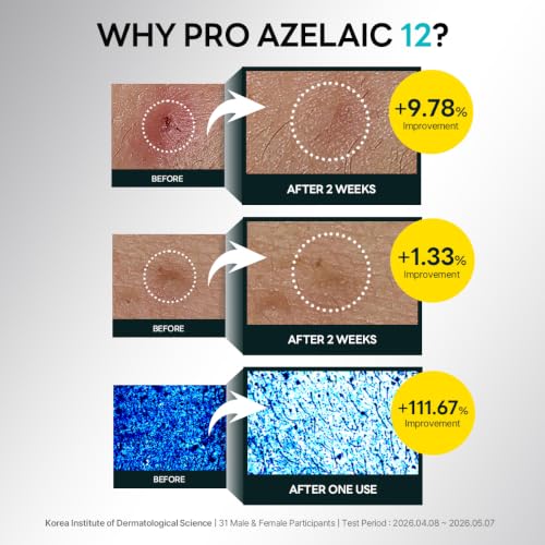 Azelaic Acid Serum 12% for Rosacea & Acne Prone Skin - Soothing & Brightening