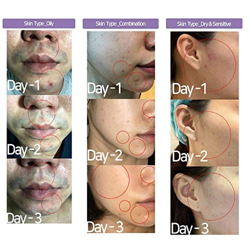 ACSEN AC Spot Solution, Concentrated Spot Serum, 72% Centella Asiatica Soothing Treatment for Acne, Blemishes, Irritation | Clinically Tested, Instant Calming and Cooling, Korean Skin Care
