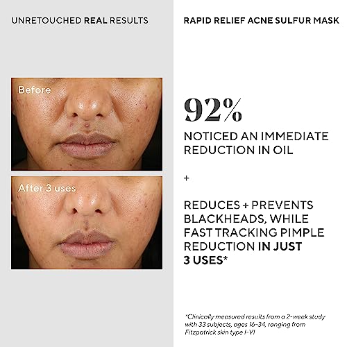 Murad Rapid Relief Acne Sulfur Mask ? Clay Mask with Salicylic Acid, 5% Sulfur, and Austrian Peat Reduces Oil, Minimizes Breakouts, Reduces Pimple Size, and Unclogs Pores ? 2.5 Fl Oz