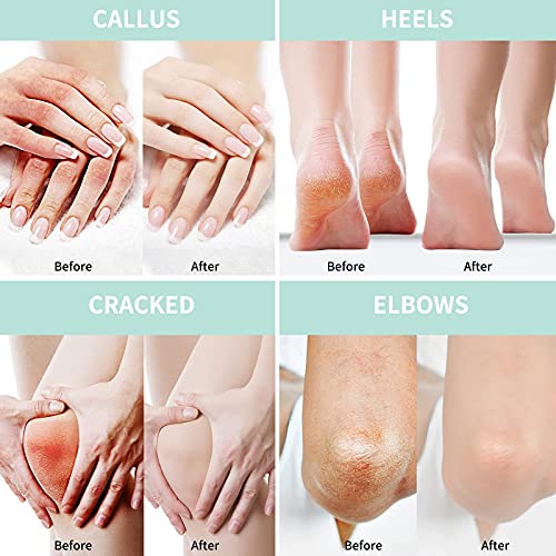 Grocerism 2 Packs Urea Cream 40% Plus 2% Salicylic Acid 5.30 oz || Foot Cream Maximum Strength with Hyaluronic Acid, Tea Tree, and Aloe Vera for Deep Moisturizes, Callus Remover and Soften