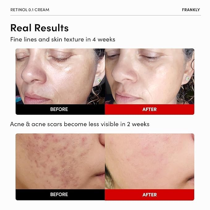 FRANKLY Skin Repair Duo with Retinol 0.1% & Vegan Butter - Anti-Aging Korean Skincare Set