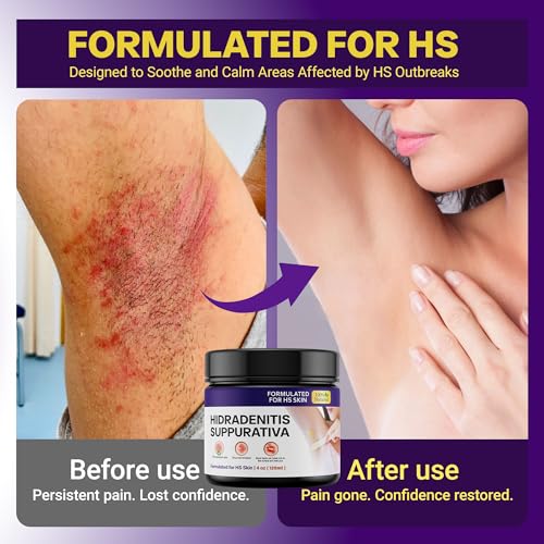 Hidradenitis Suppurativa | Fast Relief for HS Flares, Cysts, Infections, Razor Bumps, Abscesses | Natural Hidradenitis Suppurativa Cream with Propolis, Beeswax & Essential Oils ? 4 oz