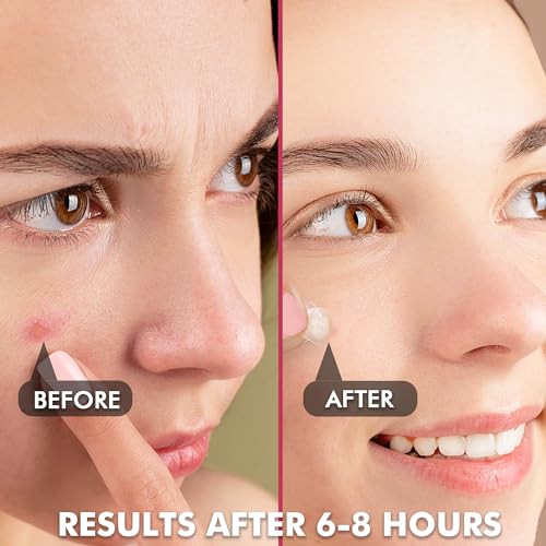 Invisible Pimple Patches Pack of 3 - 180 Count, 2 Sizes Hydrocolloid Acne Cover