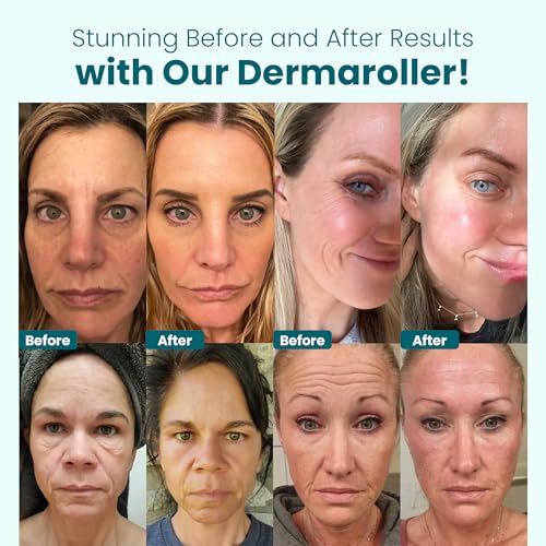 Derma Roller 0.25 mm with Individual Needles | Facial, Scalp & Head Micro-Needling Tool for Enhanced Skincare Routine - Gin Amber Beauty