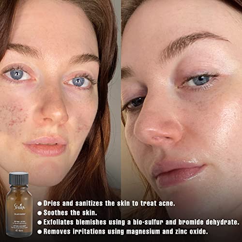 Drying Lotion for Acne & Oily Skin - Spot Treatment for Breakouts - 15ml