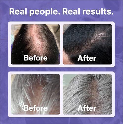 Women’s Hair Growth Minoxidil 2% Topical Solution - 2 Fl Oz