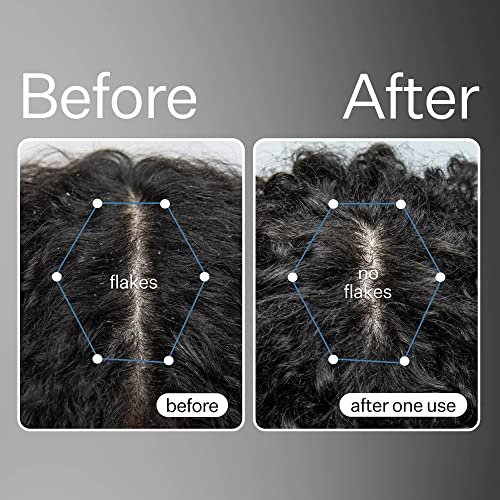 ACT+ ACRE Scalp Detox & Exfoliating Oil Bundle for Dry Itchy Scalp