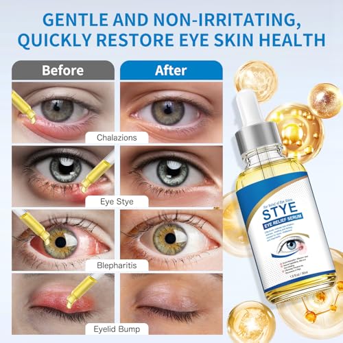 Stye Eye Treatment, Natural Stye Relief Serum for Styes, Chalazions and Blepharitis, Quickly Relieves Eye Irritation and Restores Healthier Skin,30ML