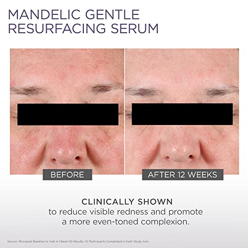 Glytone Micro-Peel 10% Mandelic Acid Serum | Anti-Aging AHA Gentle Exfoliant with Phytic Acid for all Skin types | Reduces Redness, Uneven tone & Dark Spots | Fragrance-Free, Paraben-Free - 1 Fl oz.