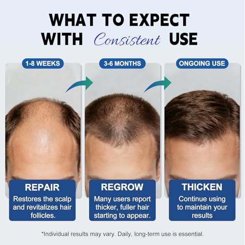 Minoxidil 5% Hair Growth Solution for Men & Women – Thinning & Receding Hair Treatment, 6 x 2 fl oz