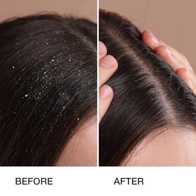 GK HAIR Anti-Dandruff Shampoo Leaving Your Scalp Refreshed and Hair Soft, Smooth ? Sulfate-Free Shampoo for Dry Damaged Hair for Men and Women 8.5 Fl Oz