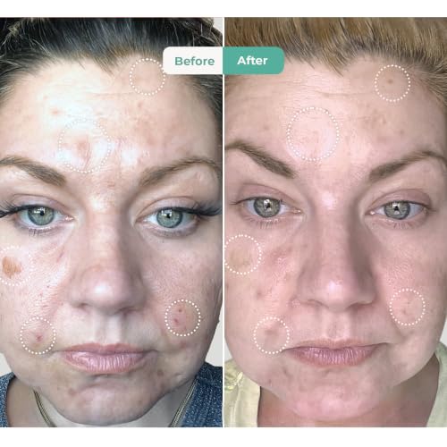 Salicylic Acne Spot Treatment Gel with Tea Tree Oil - Clears Blemishes & Prevents Breakouts