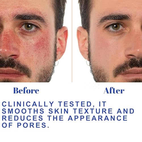 Witch Hazel Toner, Hydrating, Refreshing Face Mist, Rose Water with Salicylic, & Glycolic Acid, Zero Pore Cleanser, Removes Makeup, Dirt, Oil, Fades Dark Spots & Minimizes Pores, Alcohol-Free, 100 ml