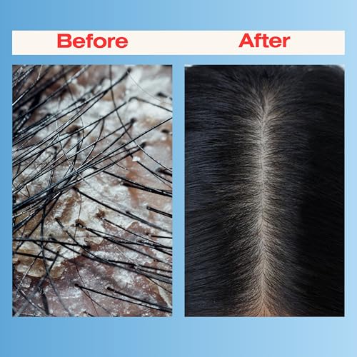 Mediceuticals Scalp Treatment Kit for Dandruff & Psoriasis - 3 Piece Therapy System