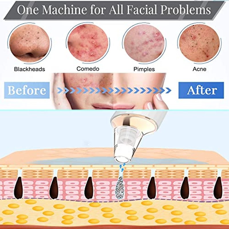 Blackhead Remover Pore Vacuum,Newest Upgraded USB Rechargeable Facial Pore Cleaner Blackhead Removal Kit with 3 Suction Power,5 Probes Black Head Extractions Tool for Women & Men