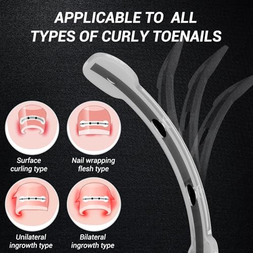 Titanium Alloy Ingrown Toenail Treatment, Nail Tools, and Ingrown Toenail Removal Kit Specially Designed for Curved Nail Repair and Ingrown Toenail Corrector (0.59/0.67in)
