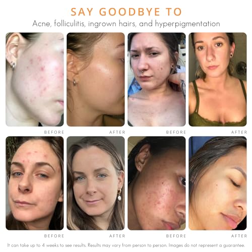 Almond Clear Level 1 Serum | Mandelic Acid Facial Serum for Acne, Folliculitis, Aging Skin, Ingrown Hairs, Dark Spots on Face, Chest, Butt, Back, Thighs, Arms | 4oz