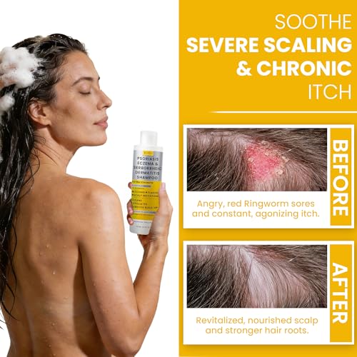 Medicated Psoriasis & Eczema Shampoo + Scrub for Itchy Scalp – Repairs & Strengthens Hair