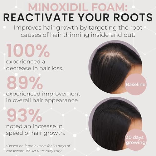 Women’s Minoxidil 5% Hair Regrowth Foam for Thinning Hair - Clinically Proven