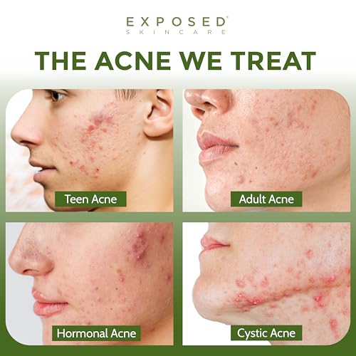 Oil-Free Hydrating Face Moisturizer for Acne-Prone Skin - Brighten & Nourish