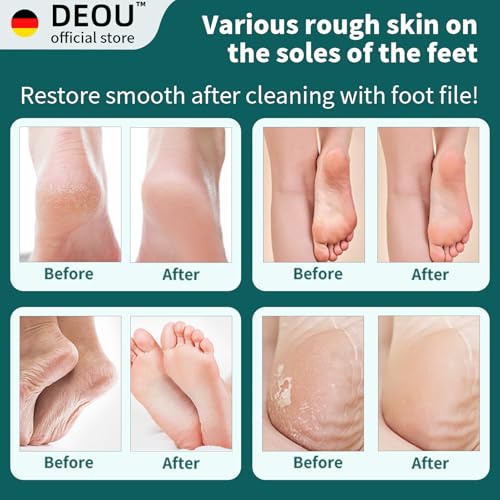 DEOU Metal Foot File Black - Callus Remover for Dead Skin & Heel Repair