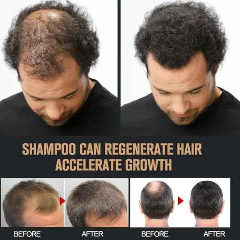2 Pcs Root Activator Shampoo, Hair Growth Root Activator Shampoo, For Anti-Hair Loss, Natural Formula for Men and Women
