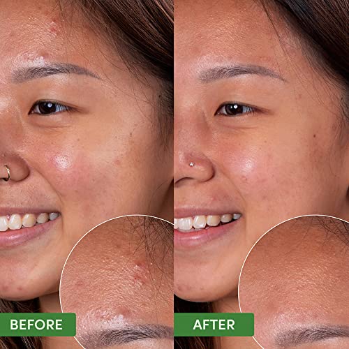 Salicylic Acid Face Wash for Acne & Oil Control - Gentle pH-Balanced Cleanser, 4oz
