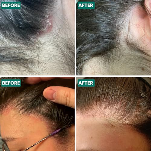 Scalp Relief Oil - Natural Dry, Itchy & Flaky Scalp Treatment, Hydrating & Soothing - 3.38 fl oz - Variation of This Listing