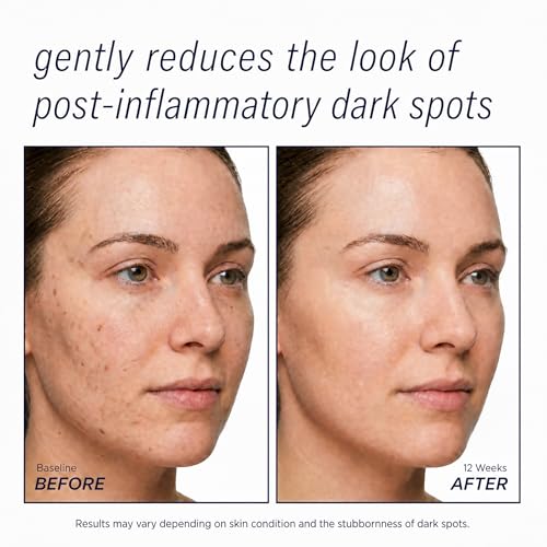 SINPIN Dark Spot Remover Serum for Face & Body - Hyperpigmentation Treatment