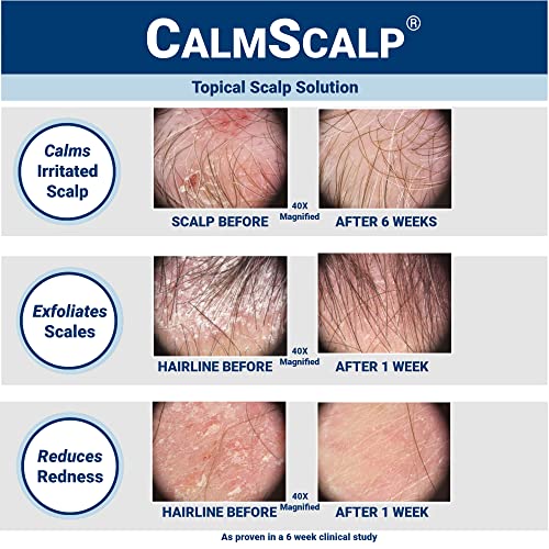 Leave-In Scalp Serum with White Vinegar 4 oz - CalmScalp Pack of 2