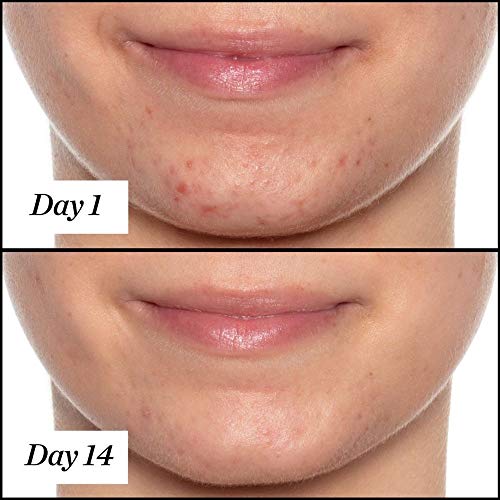 Sunday Riley U.F.O. Acne Face Oil 0.5 Fl Oz - Salicylic & Tea Tree Treatment