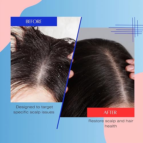 Oily Hair & Scalp Shampoo for Men Women Teens - Scalp Acne Control 8.45 oz