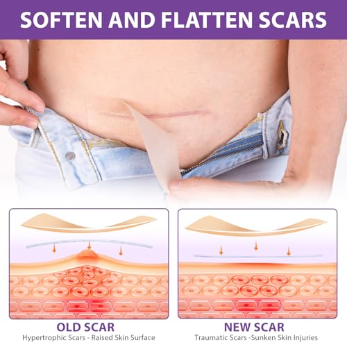 Silicone Scar Sheets, Silicone Sheets for Scars, Silicone Scar Tape for Surgical Scars, Medical Grade Scar Tape for Acne Scar Treatment, Stretch Marks, Tummy Tuck (1.6¡±x 60¡±), Roll-1.5M